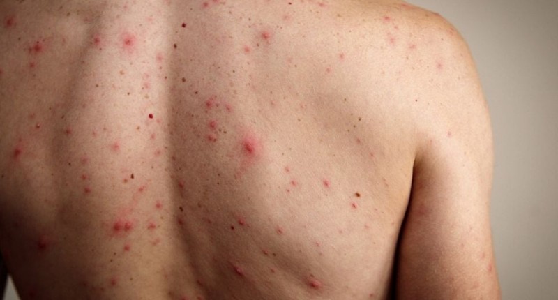 SARAMPIÓN EN MÉXICO: JALISCO ORDENA EL USO DE CUBREBOCAS EN ESCUELAS PARA EVITAR CONTAGIOS